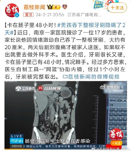 Teen Swallows 20cm Toothbrush, Undergoes Risky Endoscopic Procedure to Remove It