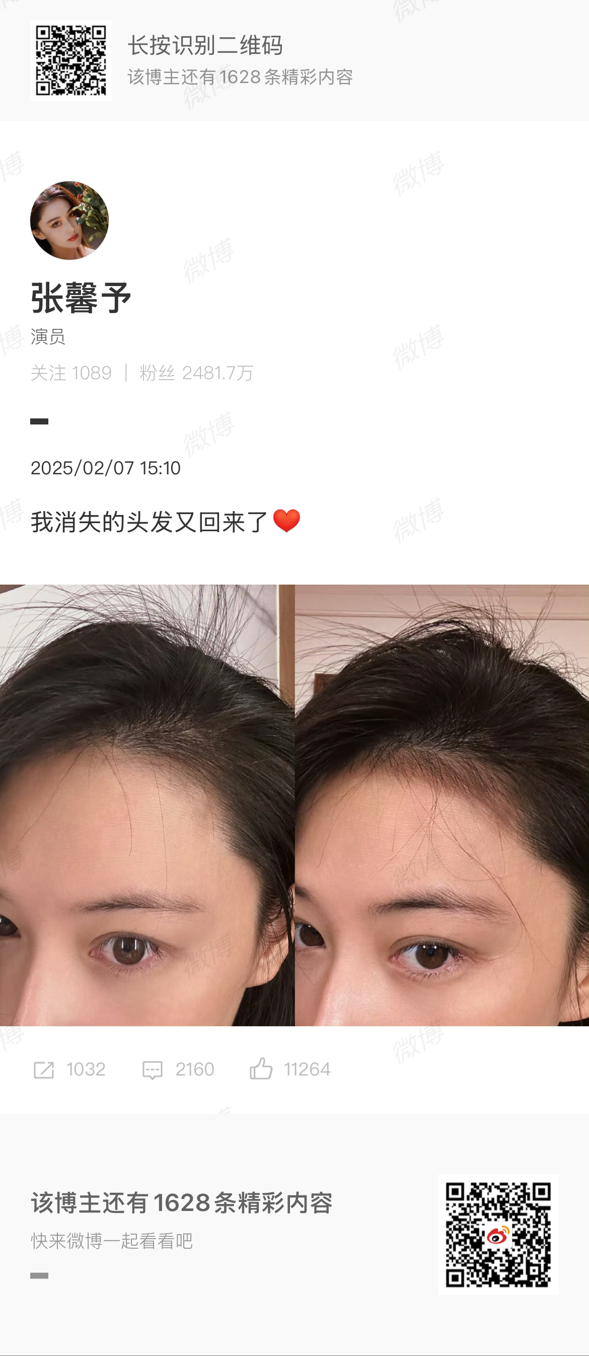 Zhang Xinyu's Miraculous Hair Regrowth: A Story of Resilience and Inner Beauty